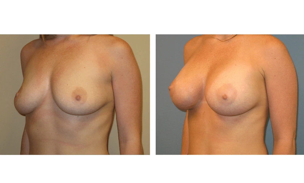 Breast Augmentation - Case 4 (4)