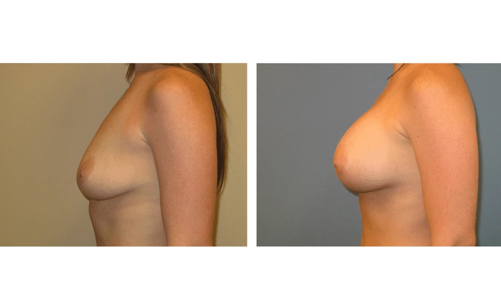 Breast Augmentation - Case 4 (5)