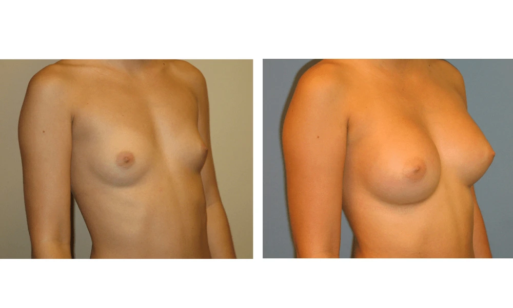 Breast Augmentation - Case 5 (2)