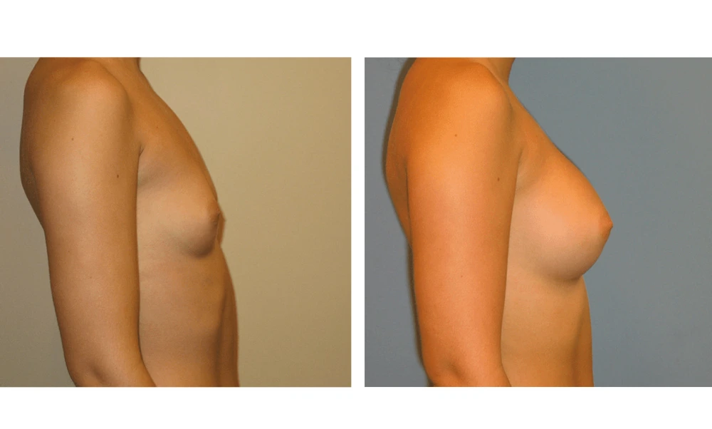Breast Augmentation - Case 5 (3)