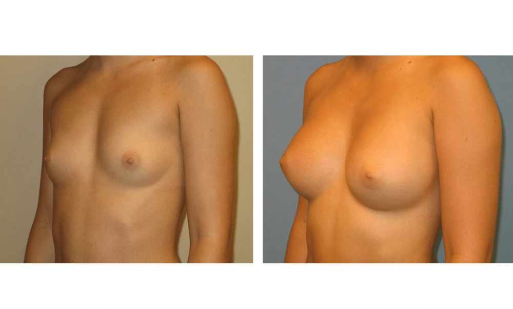 Breast Augmentation - Case 5 (4)