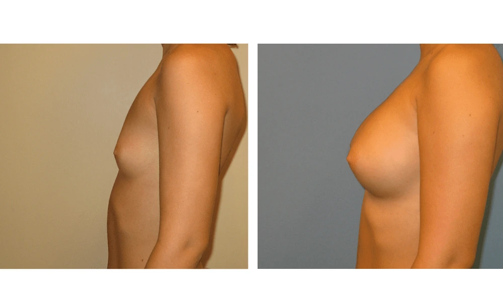 Breast Augmentation - Case 5 (5)
