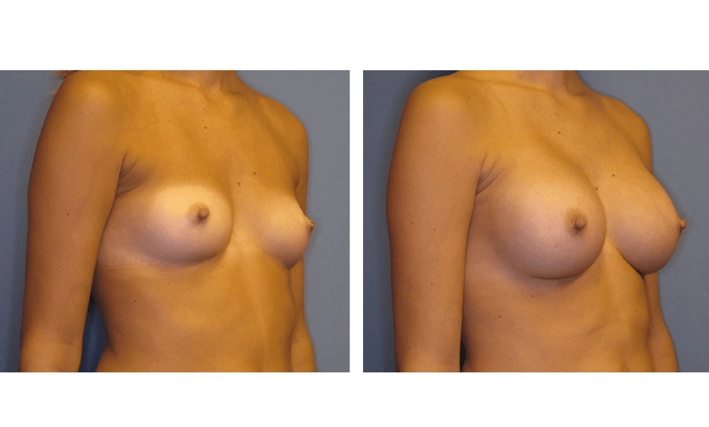 Breast Augmentation - Case 6 (2)