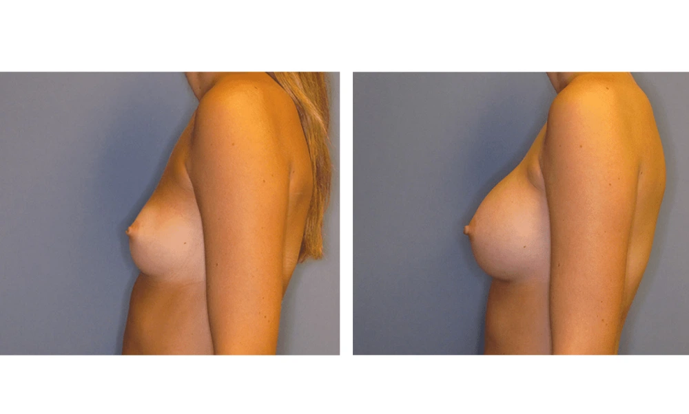 Breast Augmentation - Case 6 (5)
