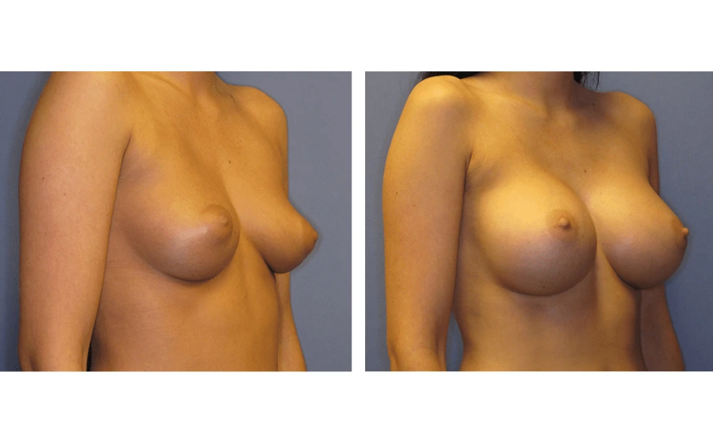 Breast Augmentation - Case 7 (2)