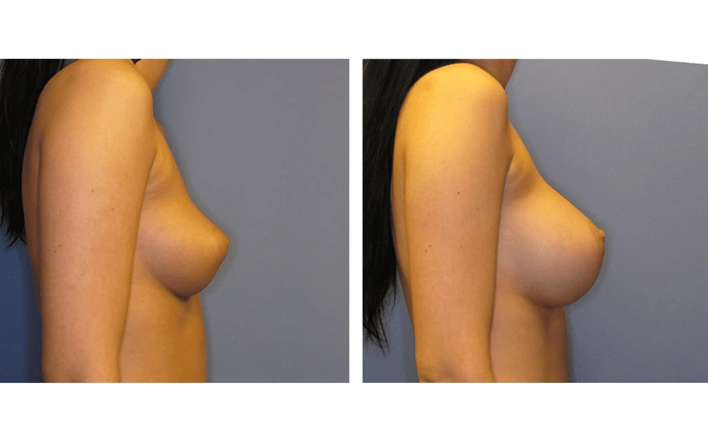 Breast Augmentation - Case 7 (3)