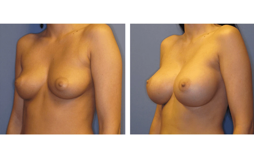 Breast Augmentation - Case 7 (4)