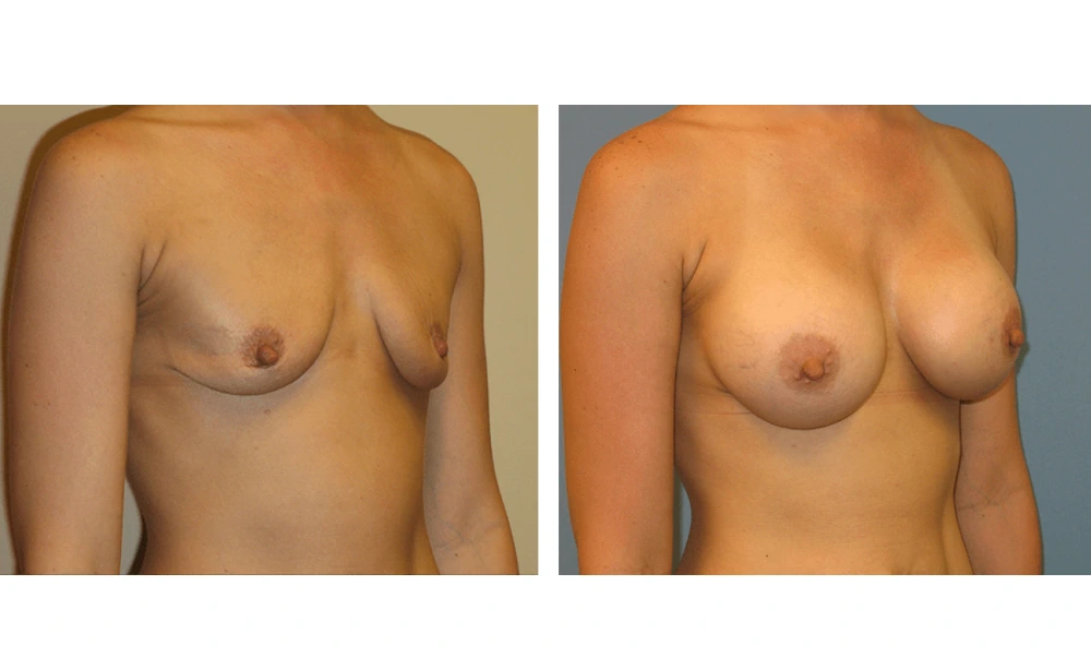 Breast Augmentation - Case 8 (2)