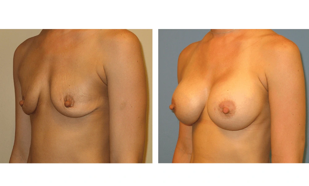 Breast Augmentation - Case 8 (4)