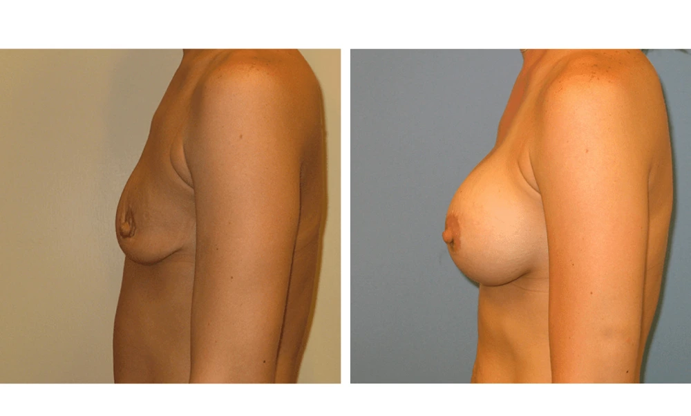 Breast Augmentation - Case 8 (5)