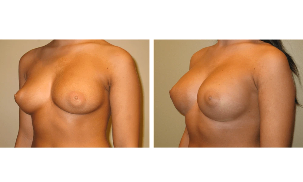 Breast Augmentation - Case 9 (4)