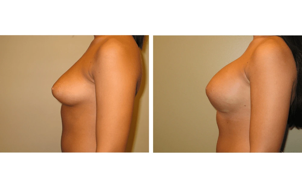 Breast Augmentation - Case 9 (5)