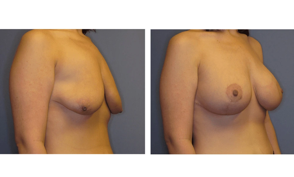 Breast Lift (Mastopexy) - Case 1 (1)