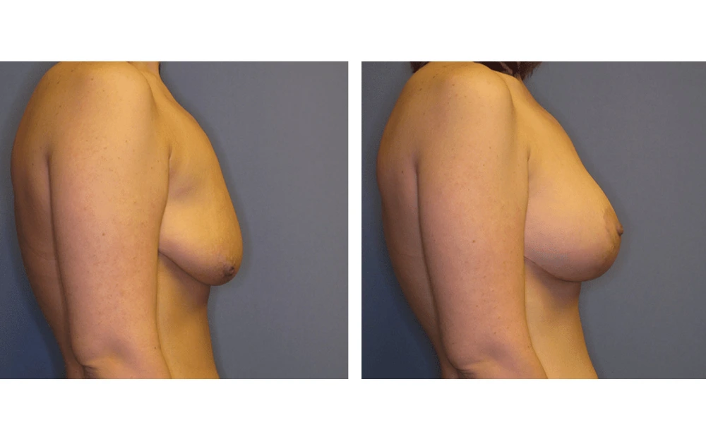 Breast Lift (Mastopexy) - Case 1 (2)