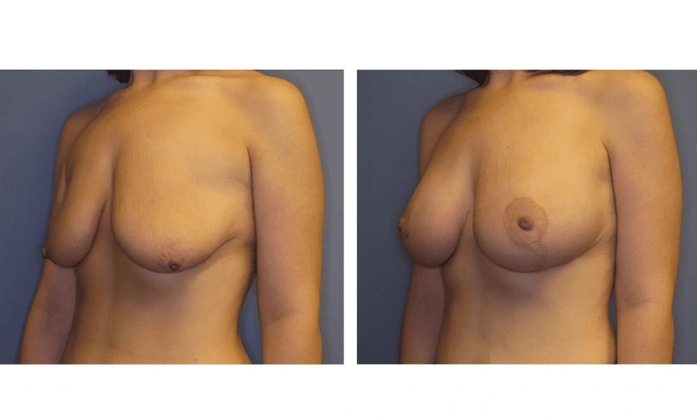 Breast Lift (Mastopexy) - Case 1 (3)
