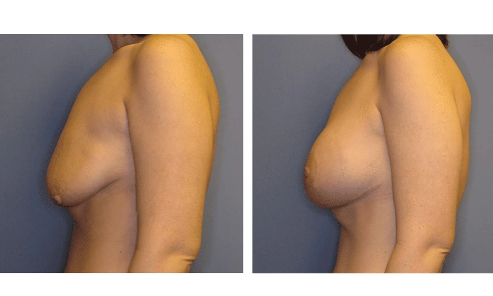 Breast Lift (Mastopexy) - Case 1 (4)