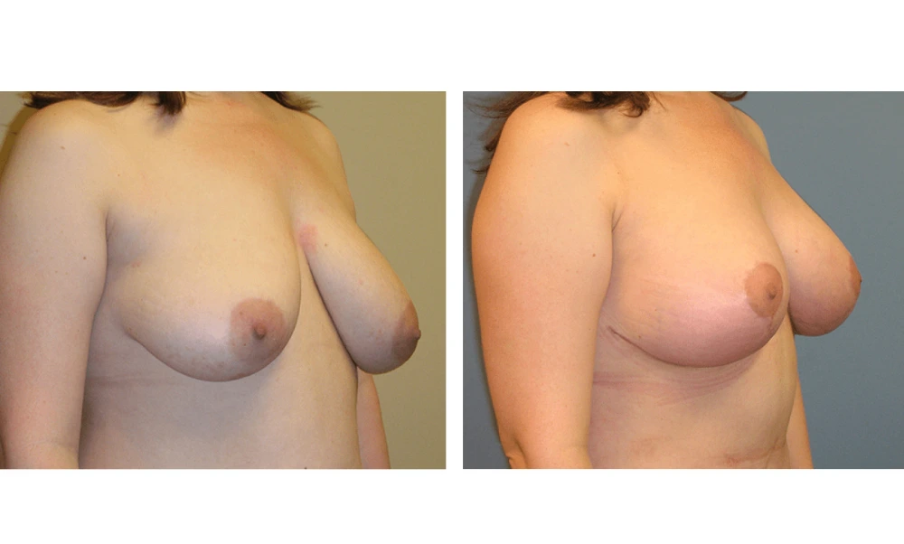 Breast Lift (Mastopexy) - Case 2 (1)