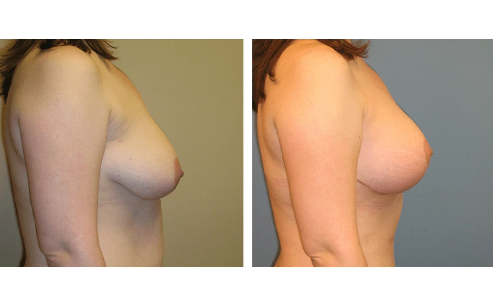 Breast Lift (Mastopexy) - Case 2 (2)