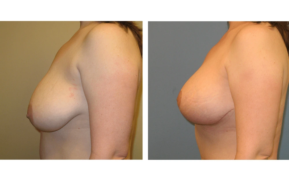 Breast Lift (Mastopexy) - Case 2 (4)