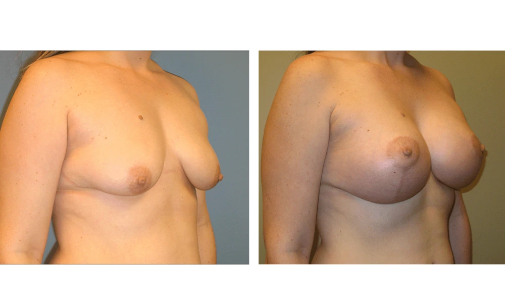 Breast Lift (Mastopexy) - Case 3 (1)