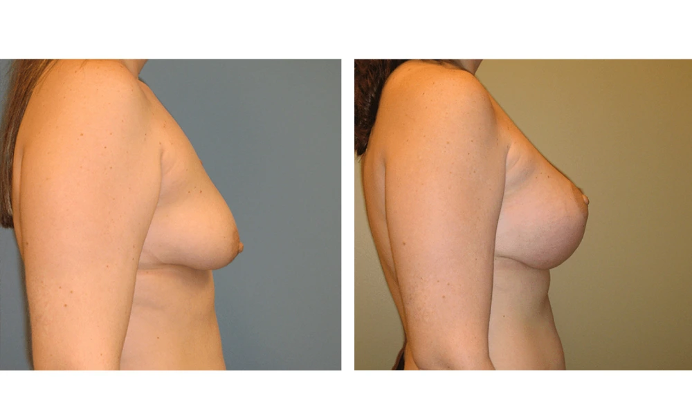 Breast Lift (Mastopexy) - Case 3 (2)