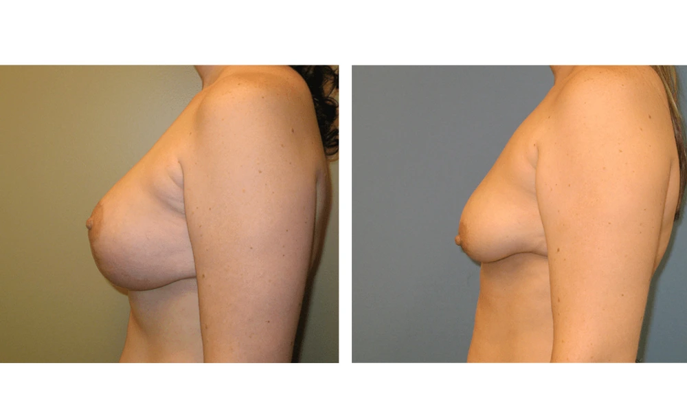 Breast Lift (Mastopexy) - Case 3 (4)