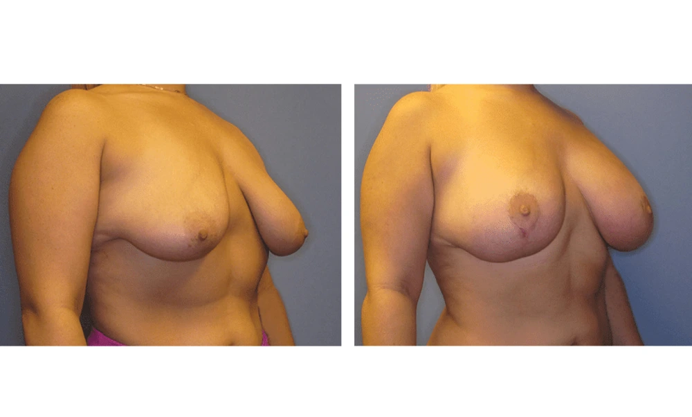 Breast Lift (Mastopexy) - Case 4 (1)