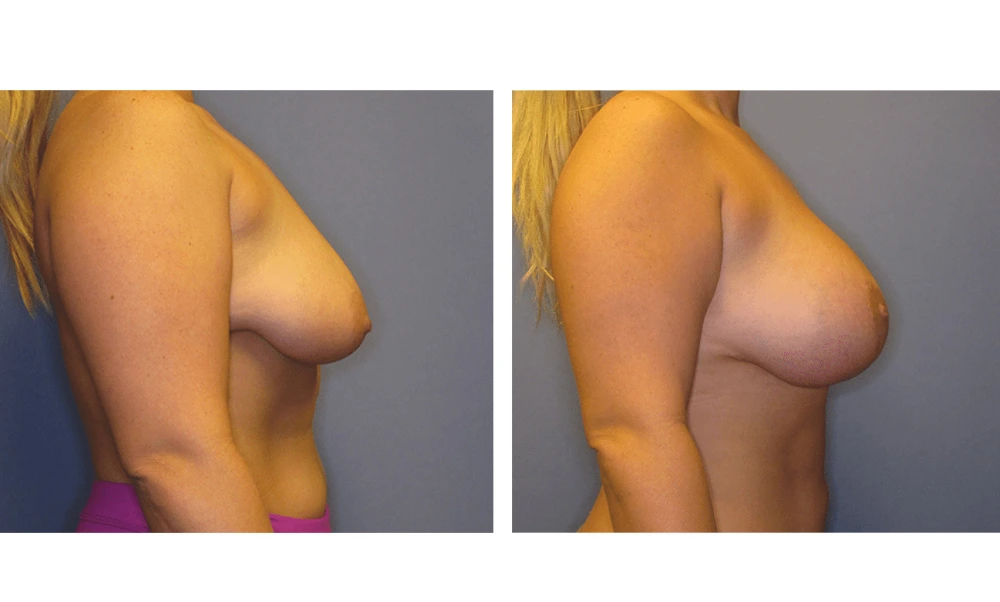 Breast Lift (Mastopexy) - Case 4 (2)