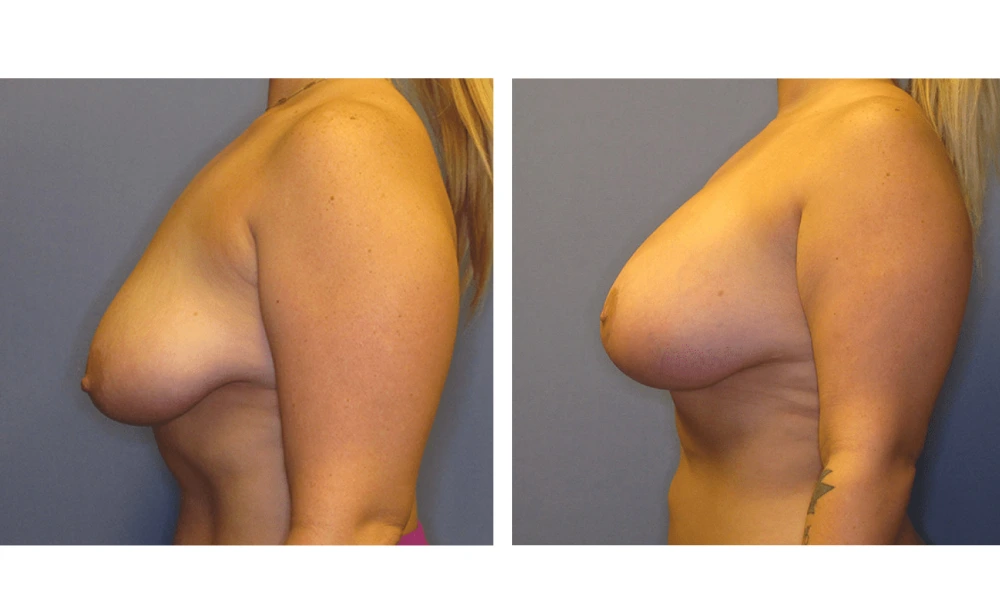 Breast Lift (Mastopexy) - Case 4 (4)