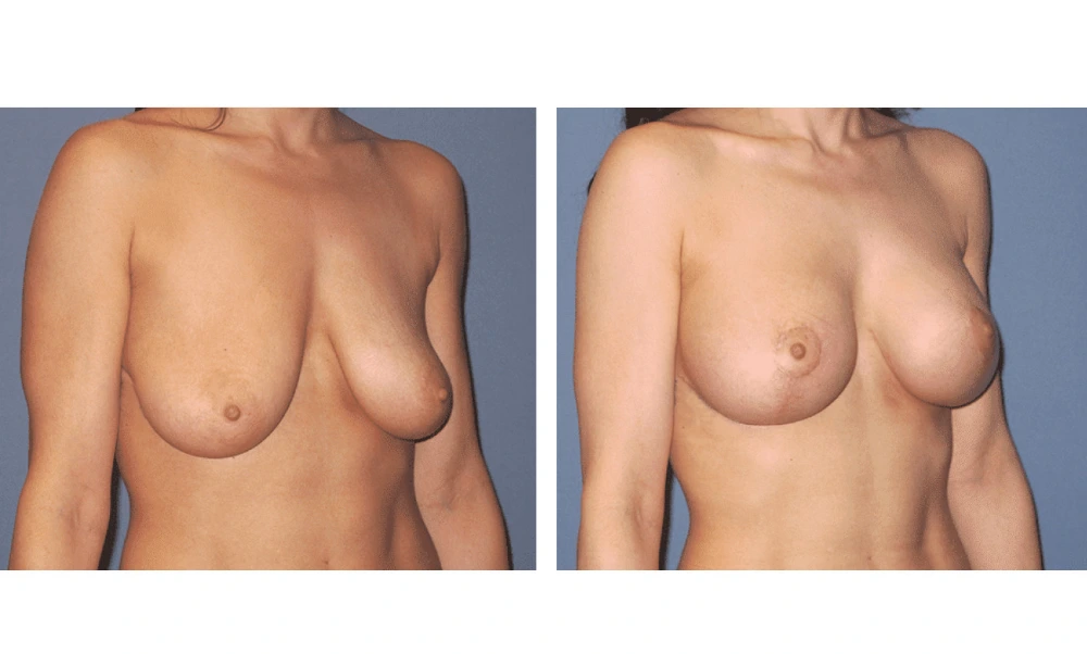 Breast Lift (Mastopexy) - Case 5 (1)