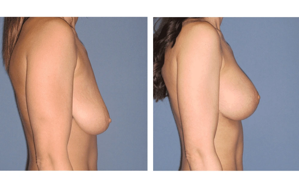 Breast Lift (Mastopexy) - Case 5 (2)