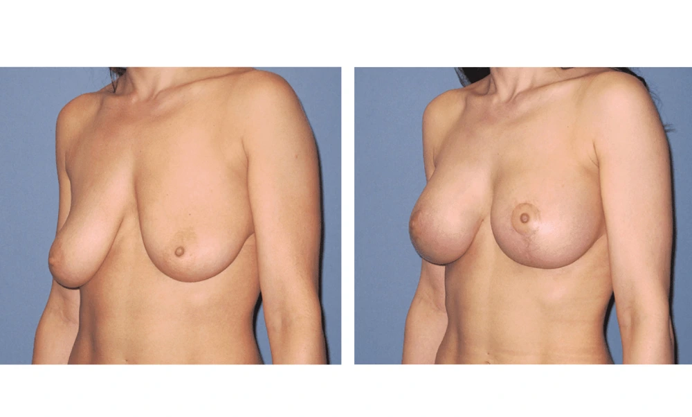 Breast Lift (Mastopexy) - Case 5 (3)