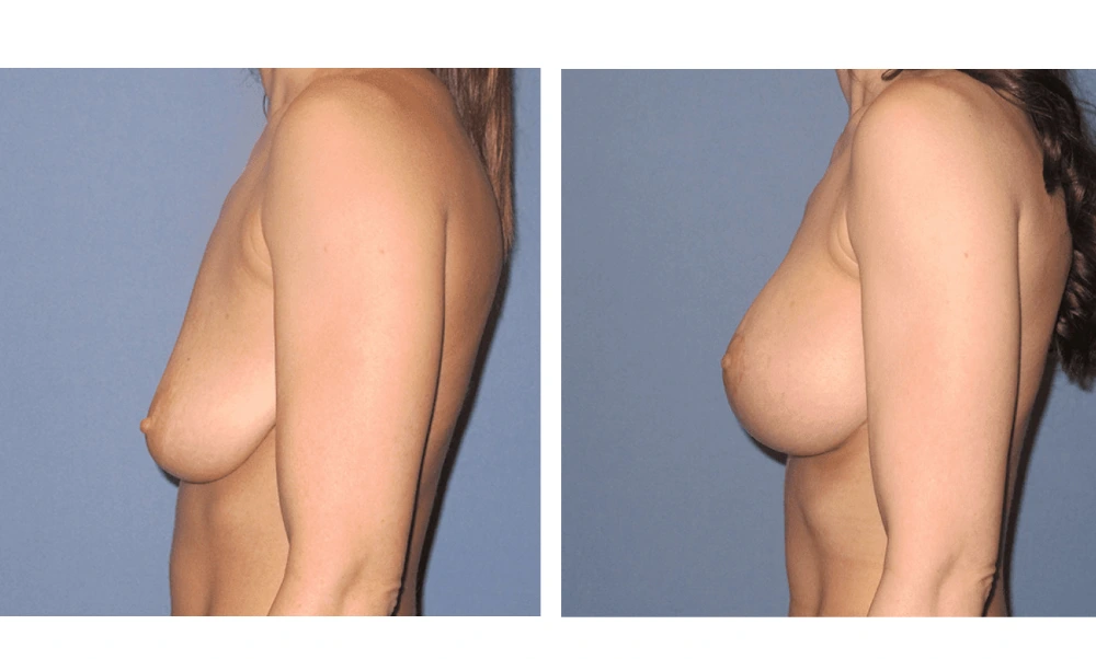 Breast Lift (Mastopexy) - Case 5 (4)