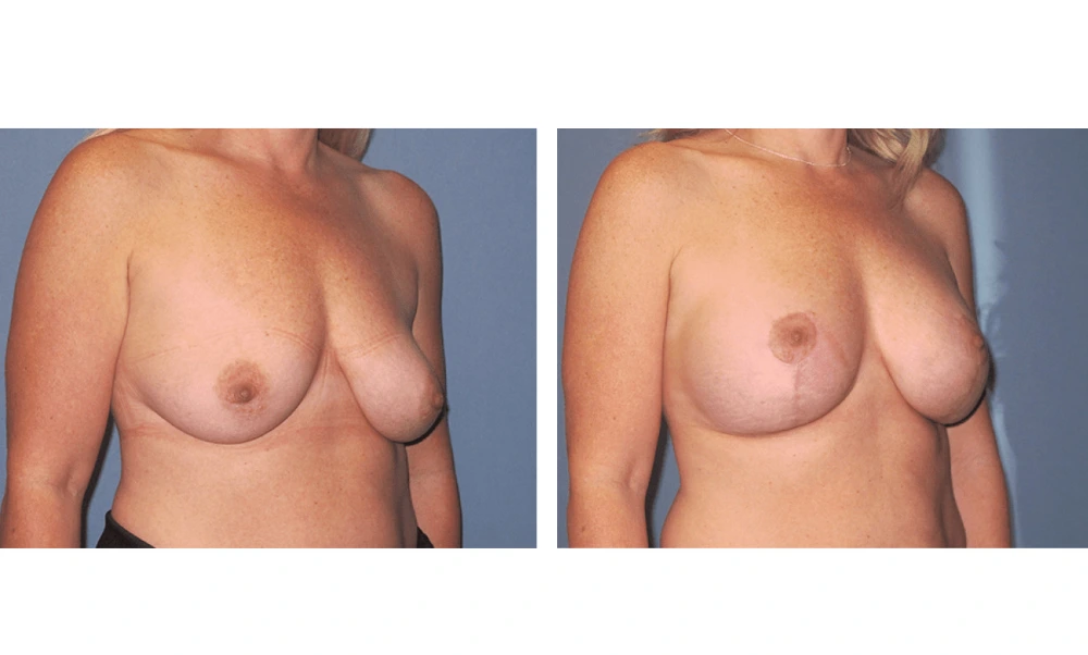 Breast Lift (Mastopexy) - Case 6 (1)