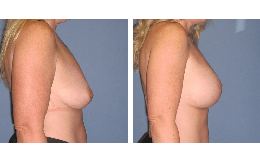 Breast Lift (Mastopexy) - Case 6 (2)