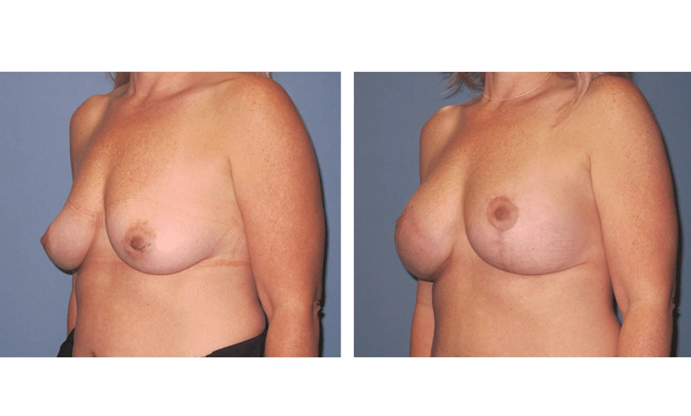 Breast Lift (Mastopexy) - Case 6 (3)