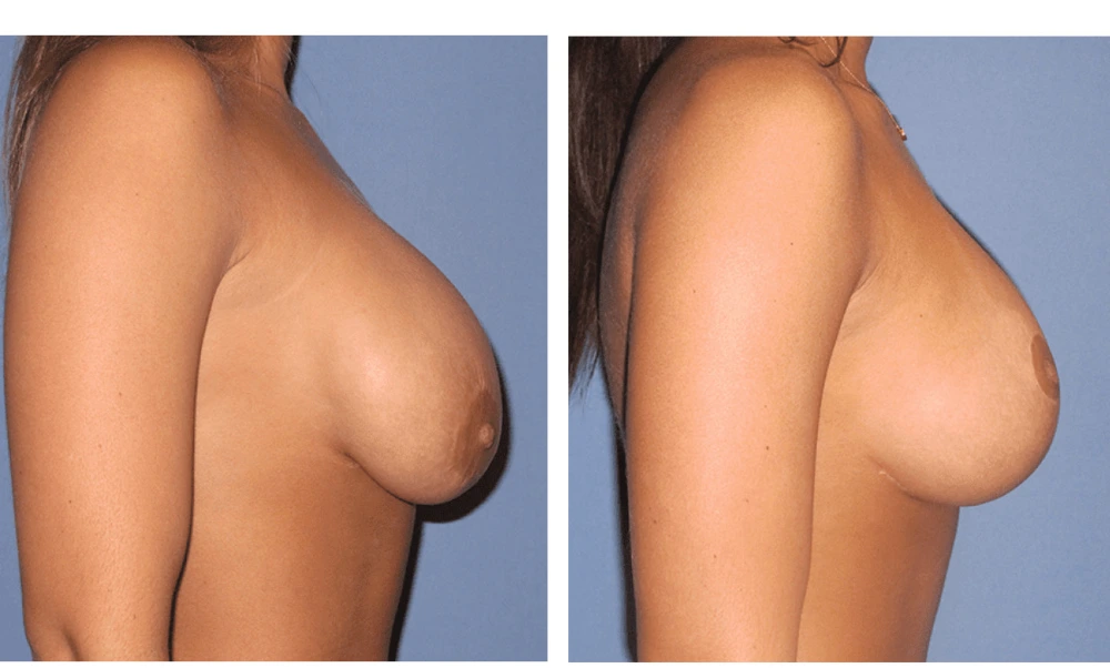 Breast Lift (Mastopexy) - Case 7 (2)