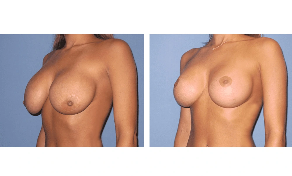 Breast Lift (Mastopexy) - Case 7 (3)