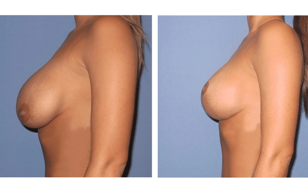 Breast Lift (Mastopexy) - Case 7 (4)