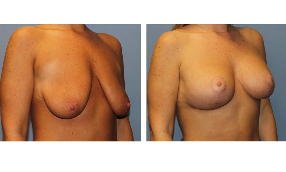 Breast Lift (Mastopexy) - Case 8 (1)