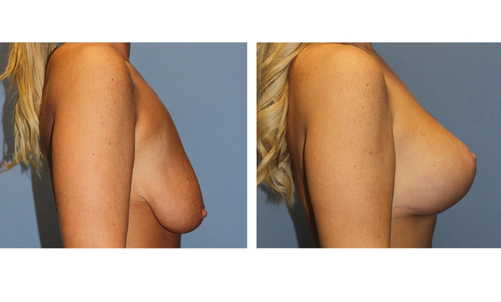 Breast Lift (Mastopexy) - Case 8 (2)