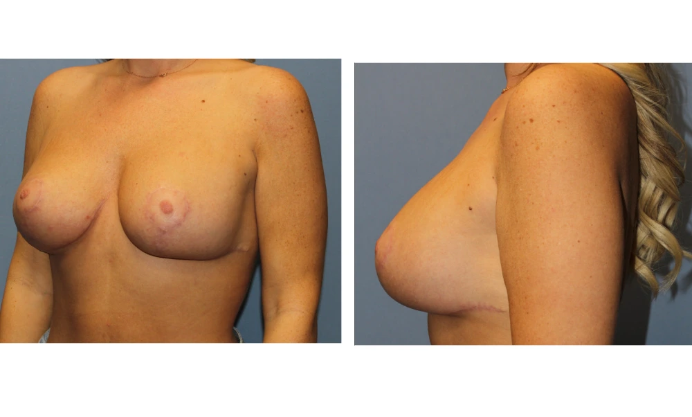 Breast Lift (Mastopexy) - Case 8 (4)