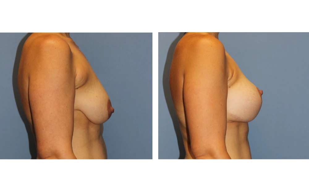 Breast Lift (Mastopexy) - Case 9 (2)