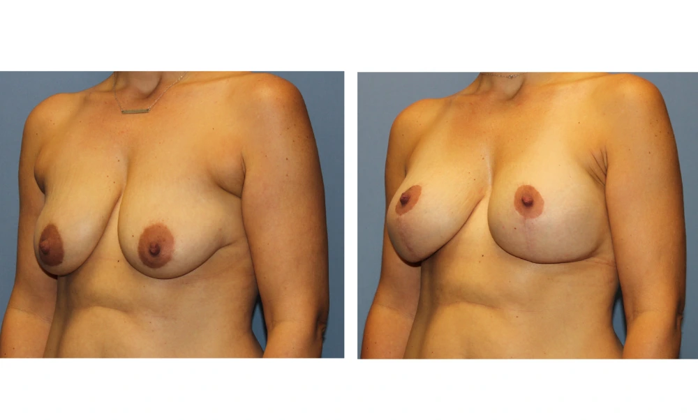 Breast Lift (Mastopexy) - Case 9 (3)