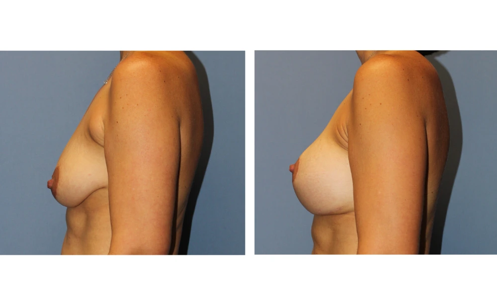 Breast Lift (Mastopexy) - Case 9 (4)