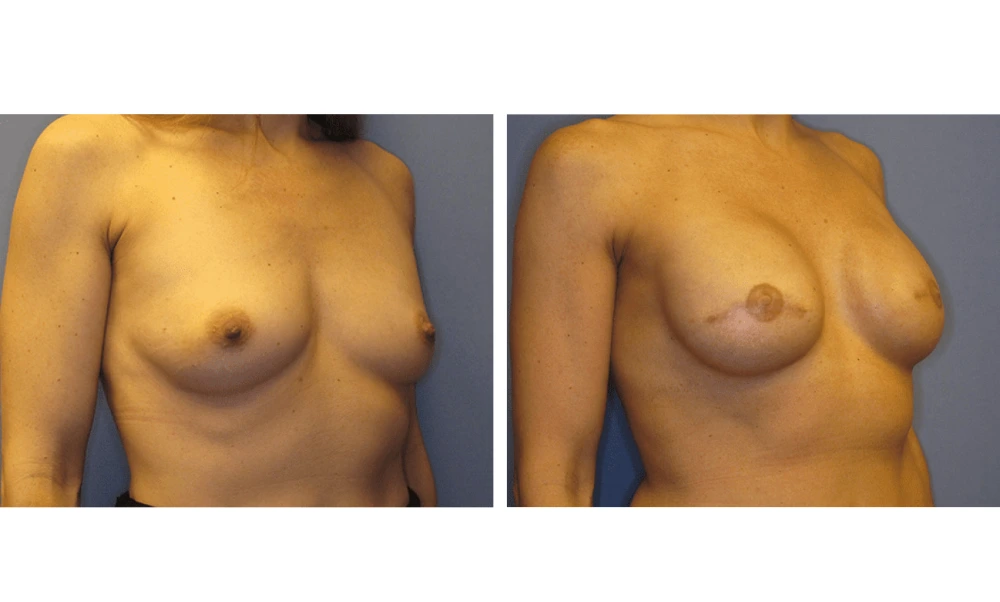 Breast Reconstruction - Case 1 (1)