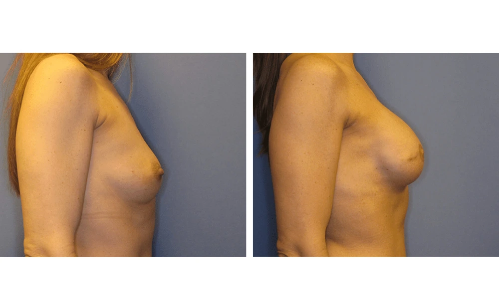 Breast Reconstruction - Case 1 (2)