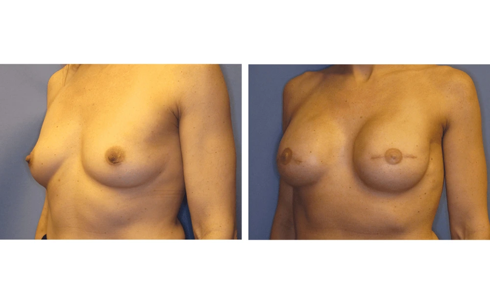 Breast Reconstruction - Case 1 (3)
