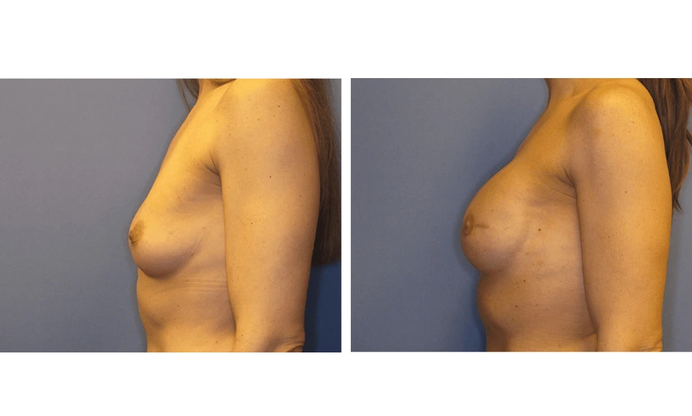Breast Reconstruction - Case 1 (4)