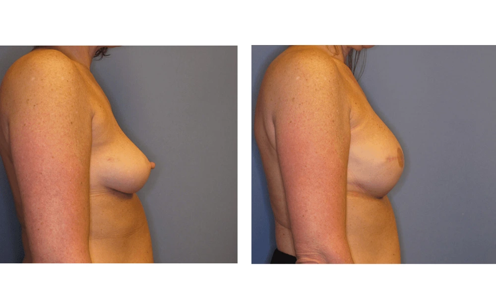 Breast Reconstruction - Case 2 (2)